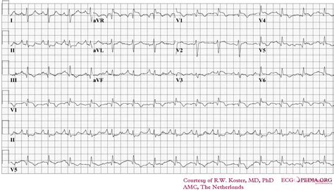 Pulmonary embolism electrocardiogram - wikidoc