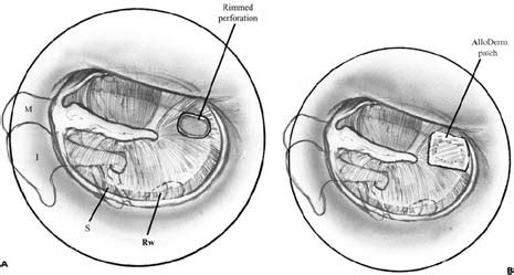 Myringoplasty | Ento Key