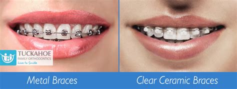 Difference Between Metal Braces and Clear, Ceramic Braces