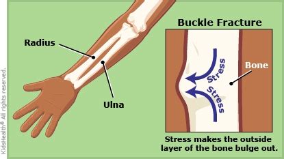 Buckle Fractures (for Parents) | Nemours KidsHealth