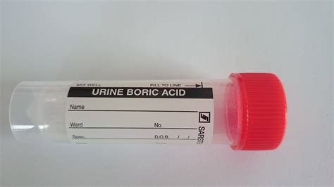 C-peptide creatinine ratio (UCPCR): Urine / Blood Sciences Test / Exeter Clinical Laboratory ...