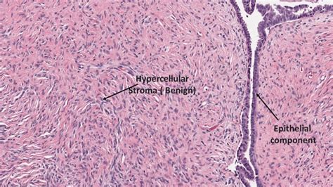 PHYLLODES TUMOR - Pathology Made Simple