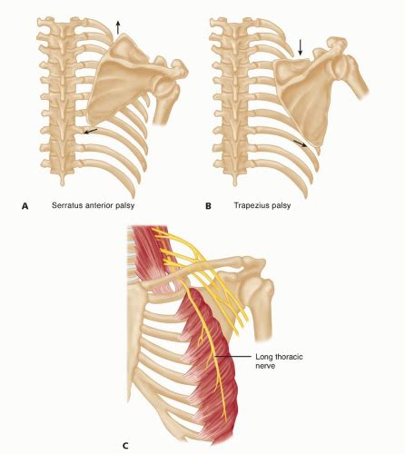 Long Thoracic Nerve Palsy