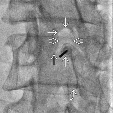 Epidural Steroid Injection, Lumbar Spine - Clinical Tree