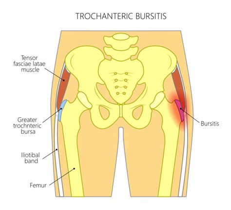 Trochanteric Bursitis - Dr. Erik Hohmann