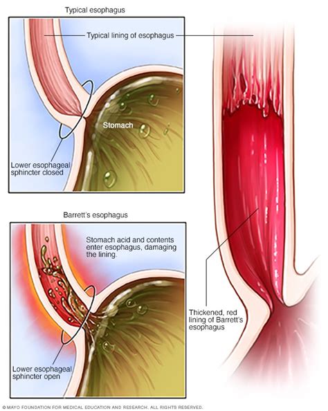 Esófago de Barrett - Síntomas y causas - Mayo Clinic