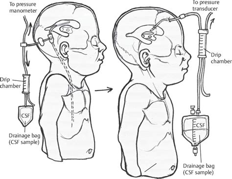 Ventriculoperitoneal Shunt Valve