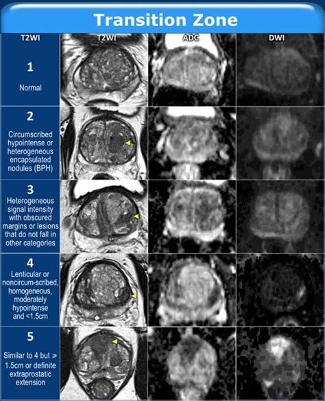 Prostate Gland Anatomy Mri