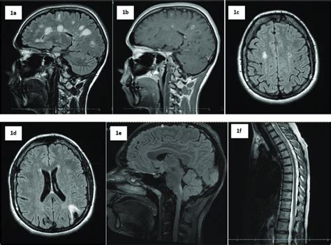 Different types of white matter lesions in CNS inflammatory diseases.... | Download Scientific ...