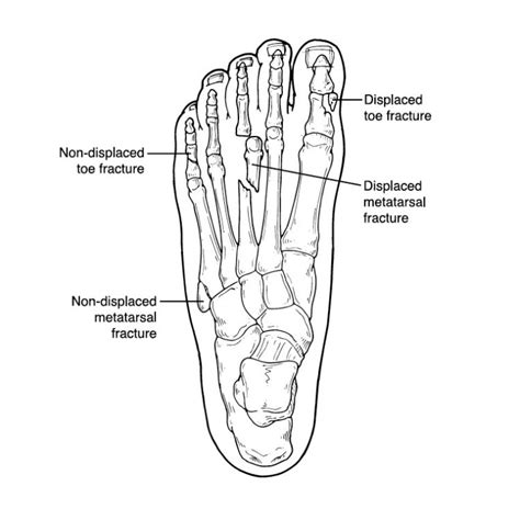 Metatarsal Bone Fracture