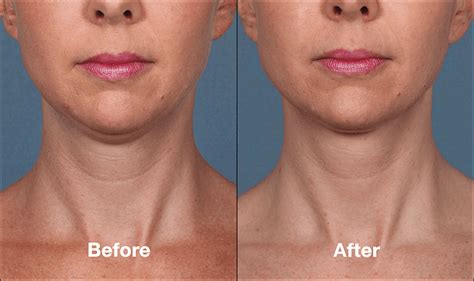 KYBELLA™ (deoxycholic acid) - Central Florida Dermatology Associates