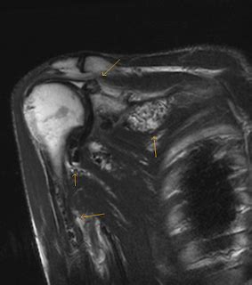 Synovial chondromatosis -MRI - Sumer's Radiology Blog