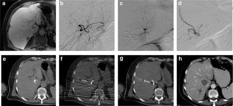 Example of liver ablation and embolization performed in an ACT room:... | Download Scientific ...