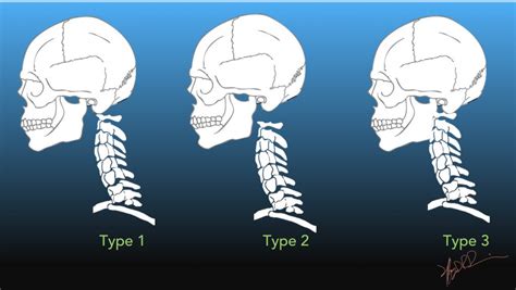 Atlanto-occipital Dissociation | UW Emergency Radiology