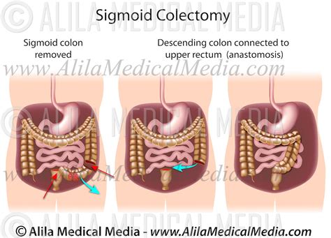 Surgical Anatomy Of Sigmoid Colon