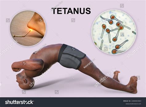 Opisthotonus Man Suffering Tetanus Bacteria Clostridium Stock ...