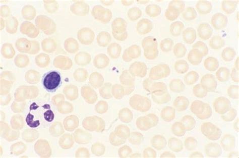 Image:Wright-Giemsa Stain of Peripheral Blood Smear-MSD Manual Professional Edition