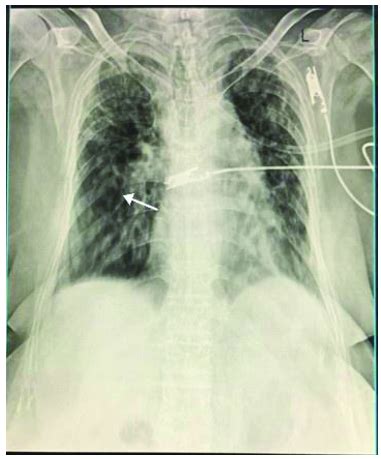 Chest X-ray showing bilateral infiltration with ring shadow suggestive ...