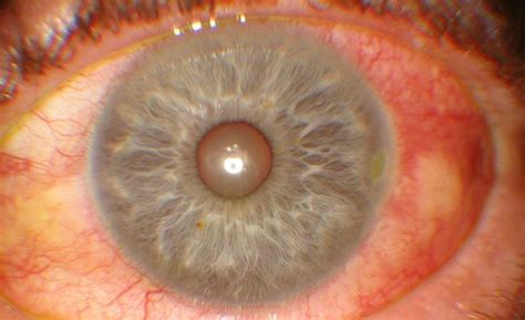 Episcleritis - Pictures, Symptoms, Treatment, Causes