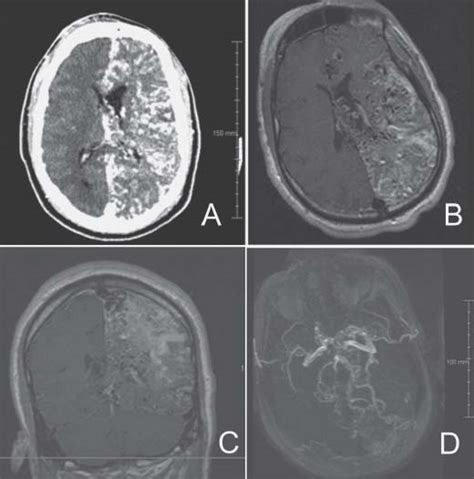 Sturge Weber Mri