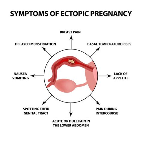 Ectopic Pregnancy Pain