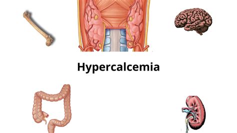 Hypercalcemia: Treatment, Pathophysiology, Symptoms