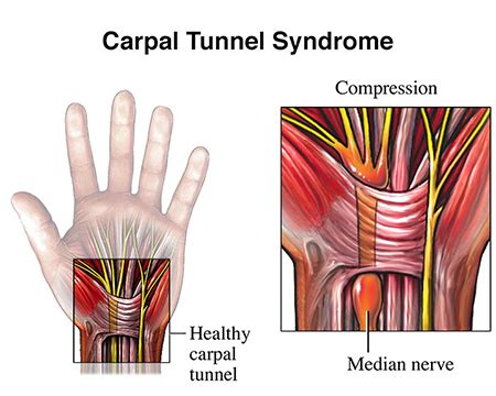 Carpal Tunnel Syndrome | Brain Institute | OHSU