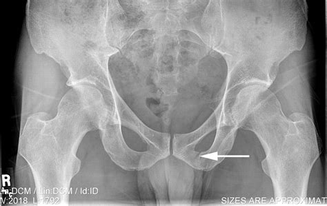 Hairline Hip Fracture - Fracture Treatment