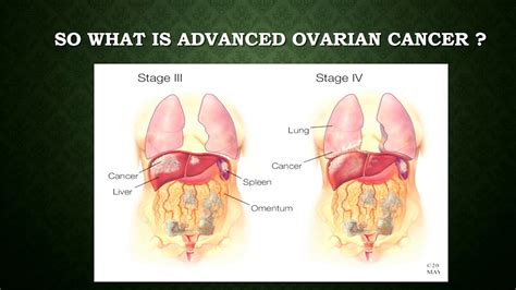 Oxford University surgical lectures: Surgery for the management of advanced ovarian cancer - YouTube