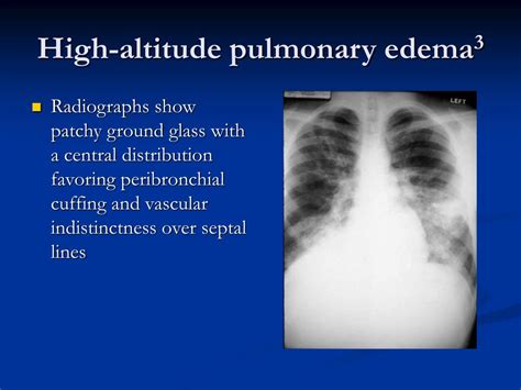 PPT - Pulmonary Edema Pathophysiological Considerations Manifestations on Chest Radiography ...