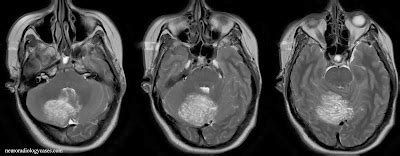 Dr Balaji Anvekar FRCR: Lhermitte Duclos disease MRI