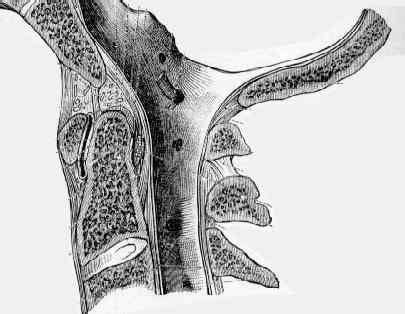 Dens Fracture : Wheeless' Textbook of Orthopaedics