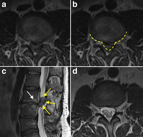 Cauda Equina Compression - MRI - Radiology at St. Vincent's University Hospital