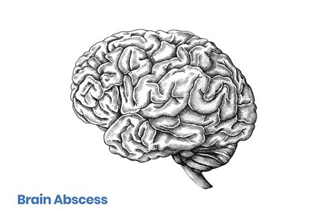 Brain abscess – symptoms, causes, diagnosis and treatment | Hyperbaric ...