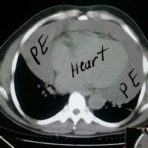 pericardial window | Download Scientific Diagram