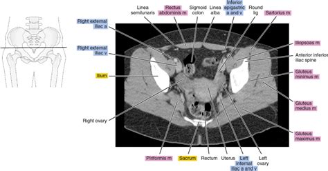 CT of the female pelvis | Radiology Key