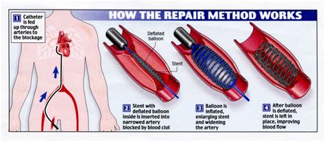 Getting Ready For Angioplasty And The Stent Procedure | HD Walls | Find Wallpapers