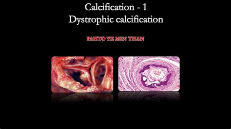 Clacification - 1 (Dystrophic calcification) - YouTube