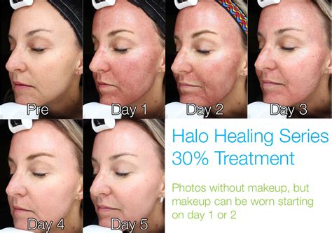 Halo Skin Laser Treatment | Resurfacing With Less Downtime