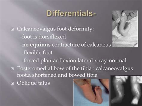 Congenital vertical talus