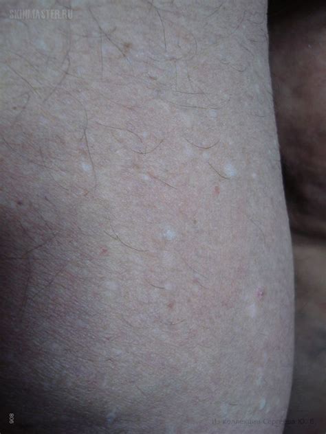 stucco keratosis - pictures, photos