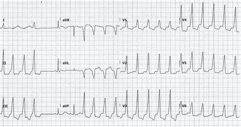 Hypocalcemia Ecg Changes