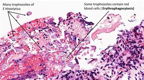 PATHOLOGY OF AMEBIC COLITIS - Pathology Made Simple