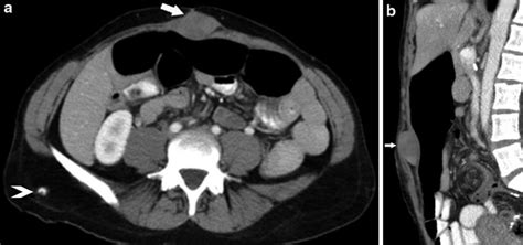 5 Abdominal wall desmoid tumor. Contrast-enhanced axial (a) and... | Download Scientific Diagram