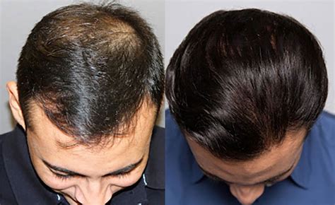 Hair Transplant Before/After Results for Men - Bosley Hair Transplant