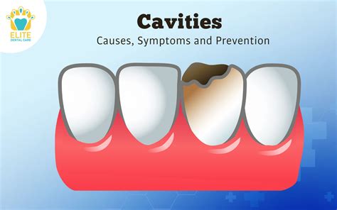 CAVITIES: CAUSES, SYMPTOMS & PREVENTION - Elite Dental Care