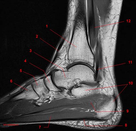 MRI of the Ankle: Detailed Anatomy - W-Radiology