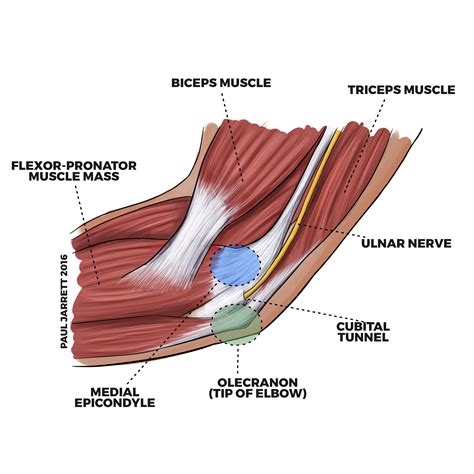 Ulnar Neuropathy at the Elbow / Cubital Tunnel Syndrome | Murdoch ...