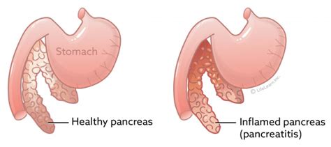 Pancreatitis in Cats | VCA Animal Hospital