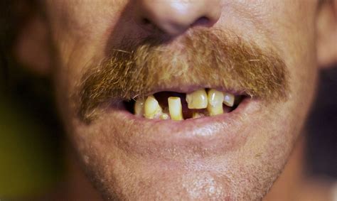 The Difference Between Rich and Poor? Eight Teeth, Says Dental Study | Cosmetic dental clinic ...